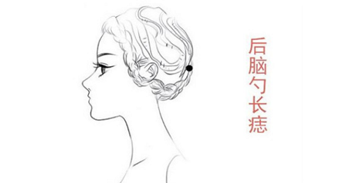 后脑勺下面有痣代表什么 后脑勺下面有痣位置图