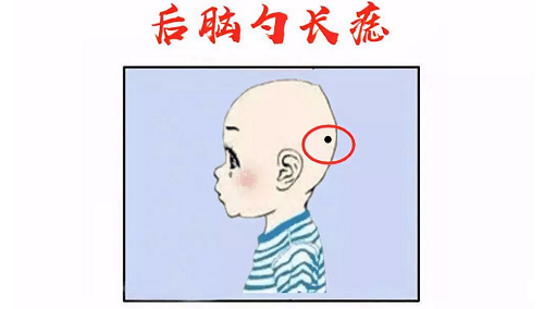 后脑勺下面有痣代表什么 后脑勺下面有痣位置图