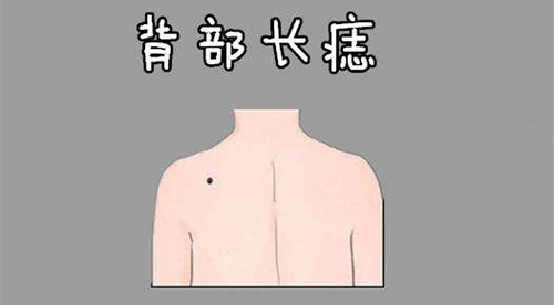 后背长痣代表什么含义男 男人背上有痣代表什么 后背长痣代表什么含义男 男人背上有痣代表什么