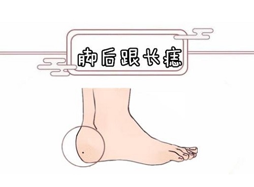 脚后跟长痣有什么寓意 脚后跟长痣的女人好不好